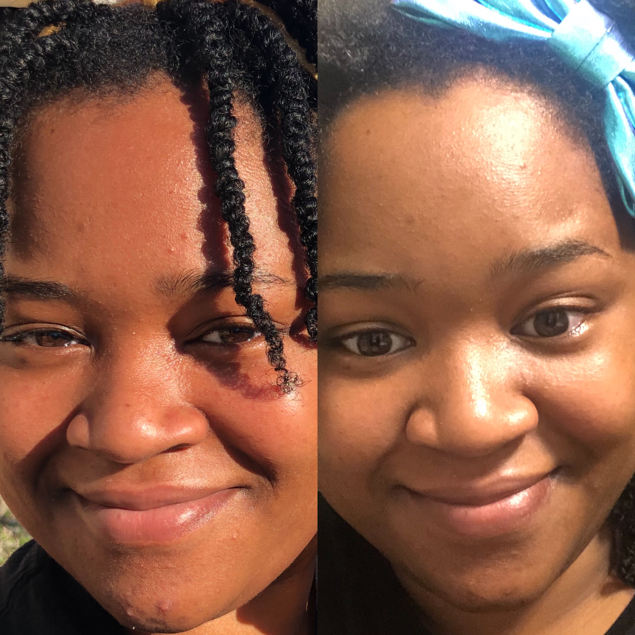 Before and After results