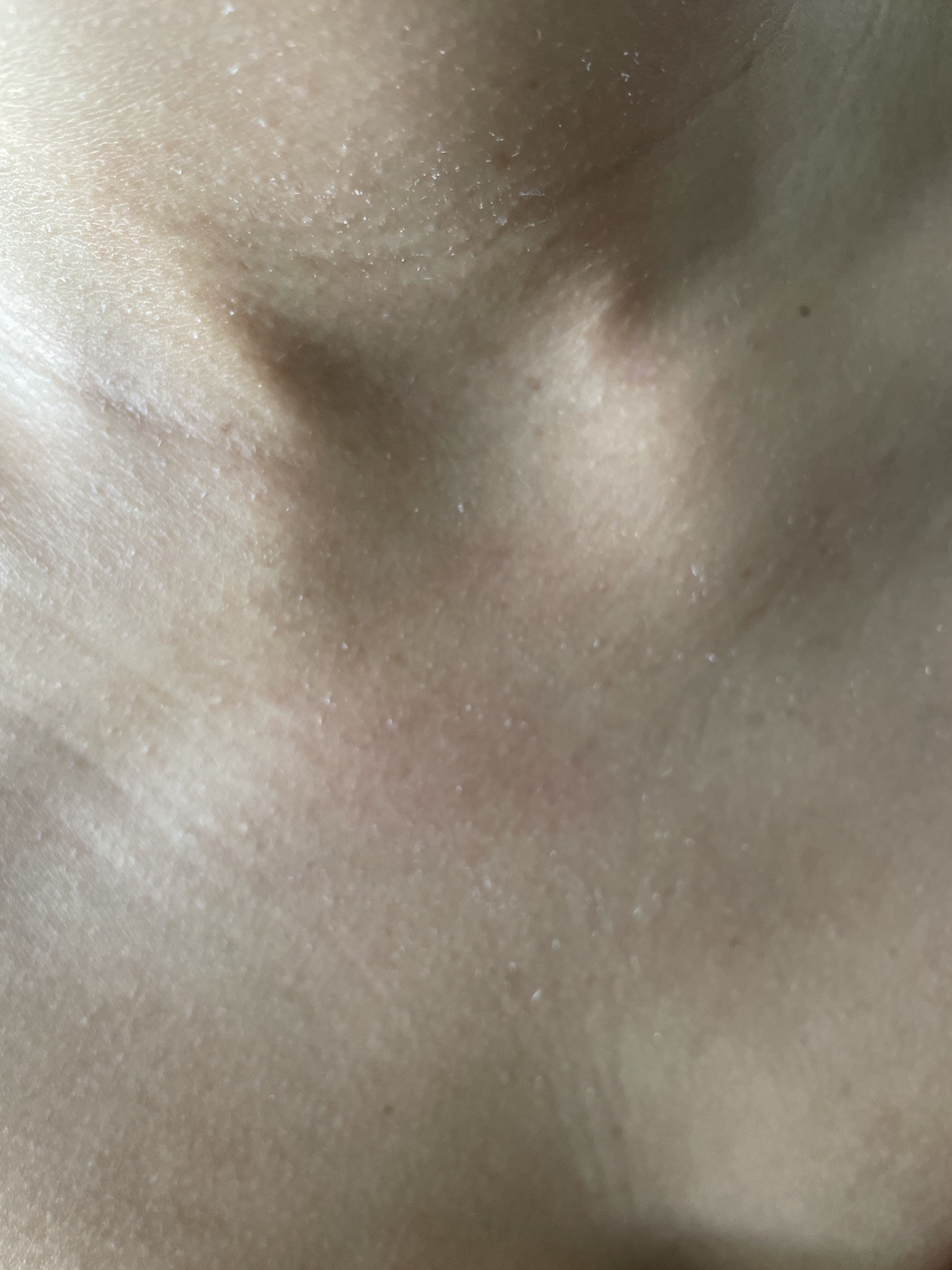 Piling on neck and chest