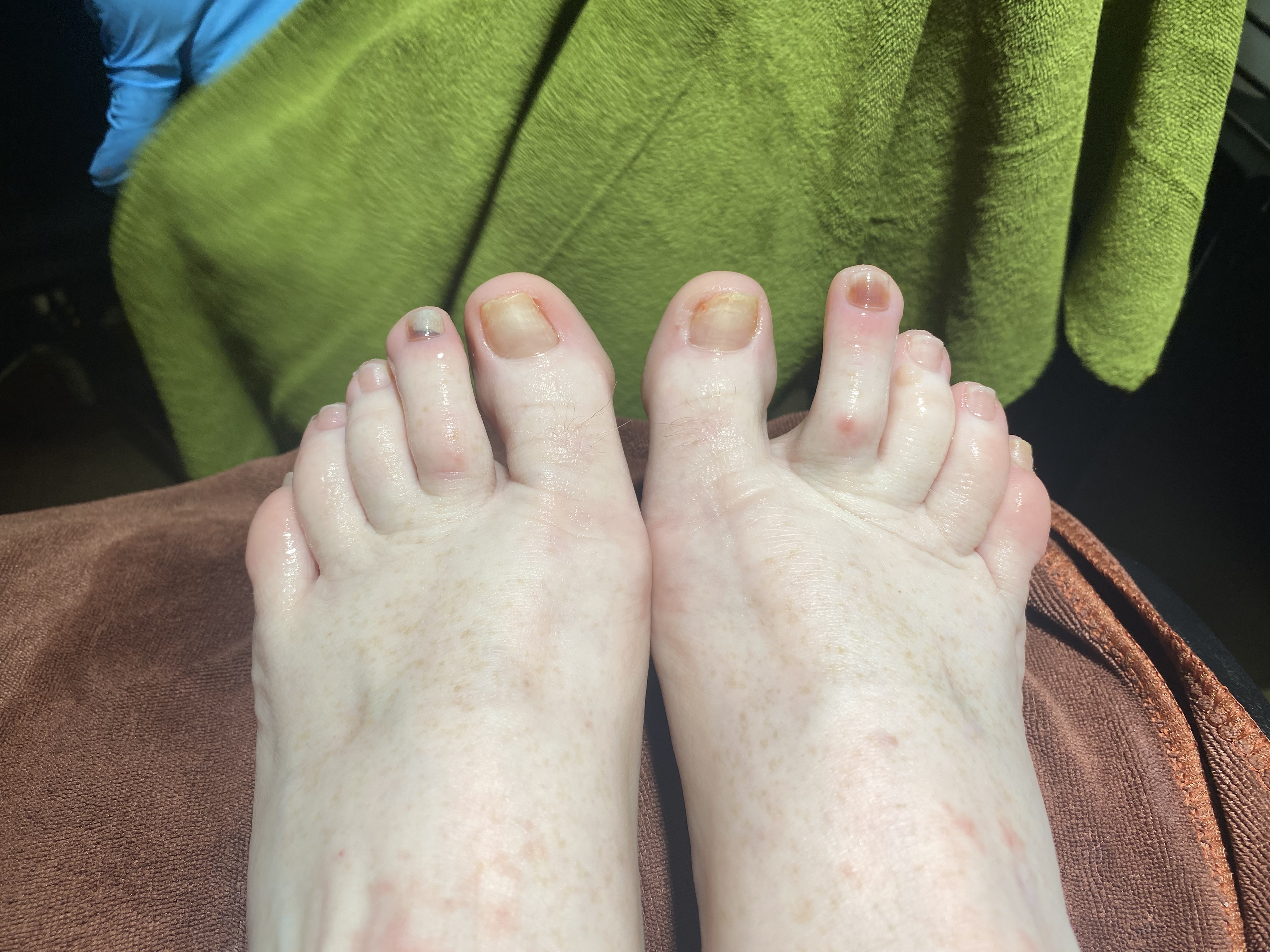Bruised toes