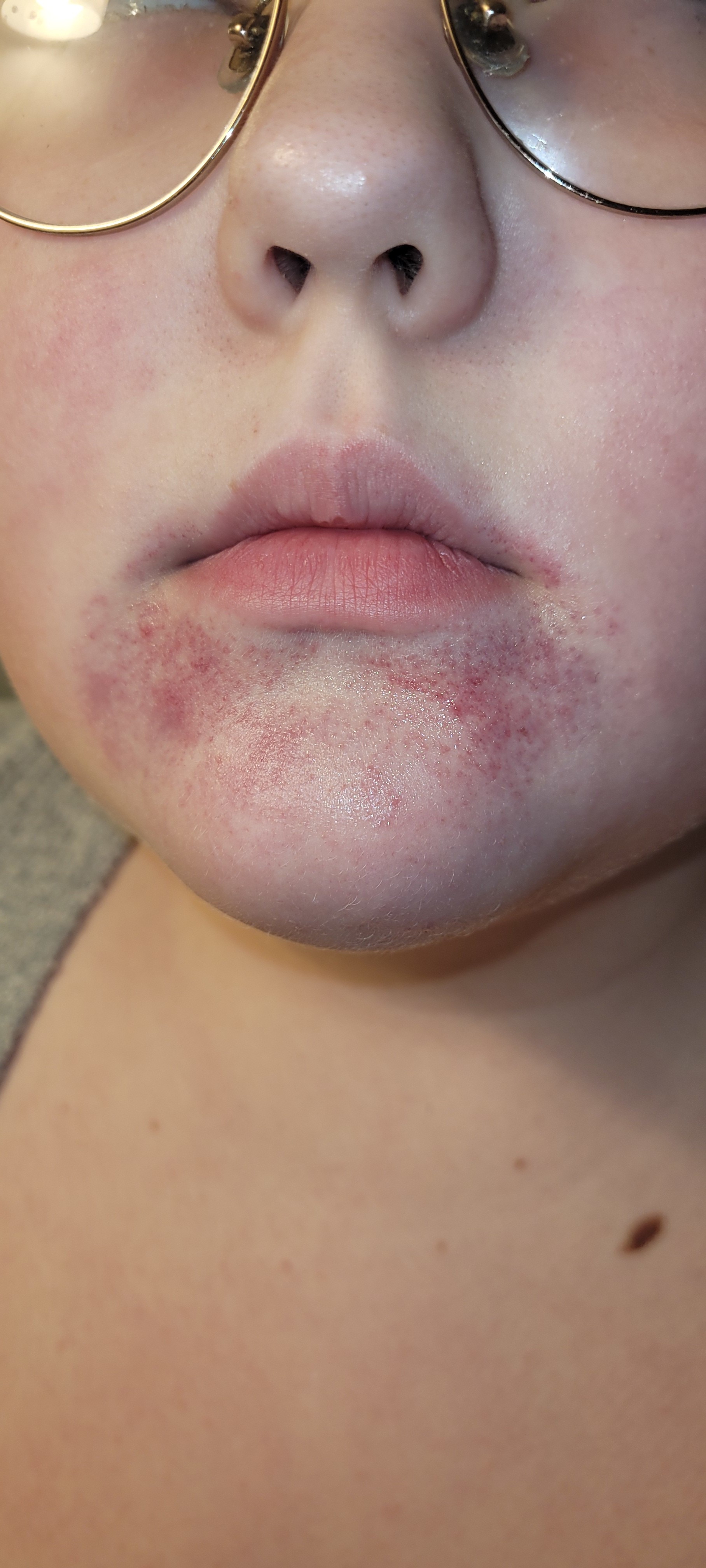 13 year old skin reaction.