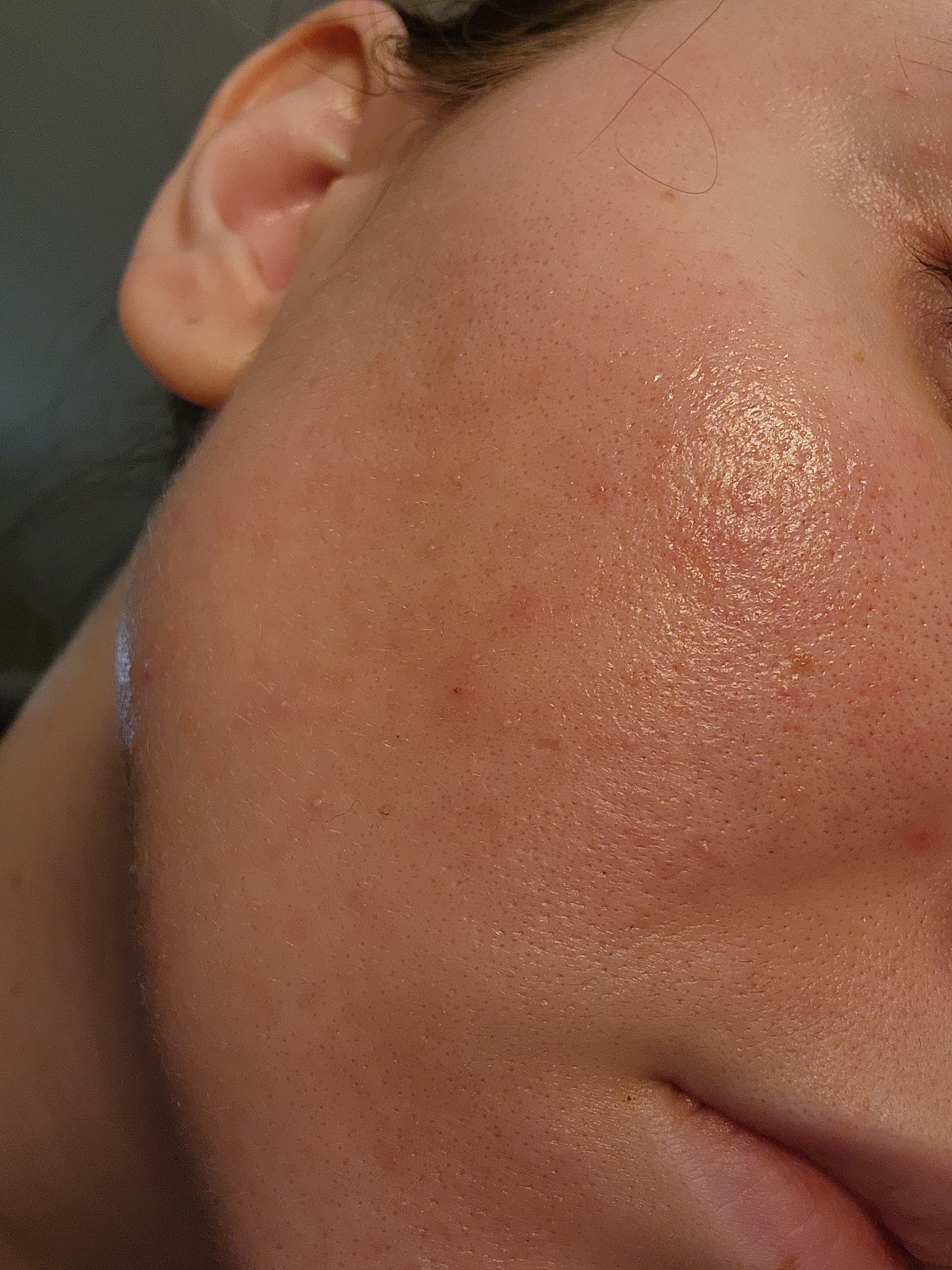 This is the rash after healing for 2 days