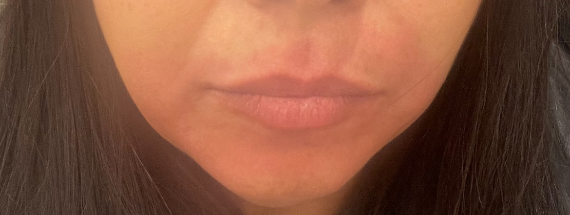 Allergic reaction after 2 mins