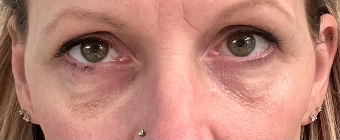 Allergies make the circles darker but the puffiness is all gone!