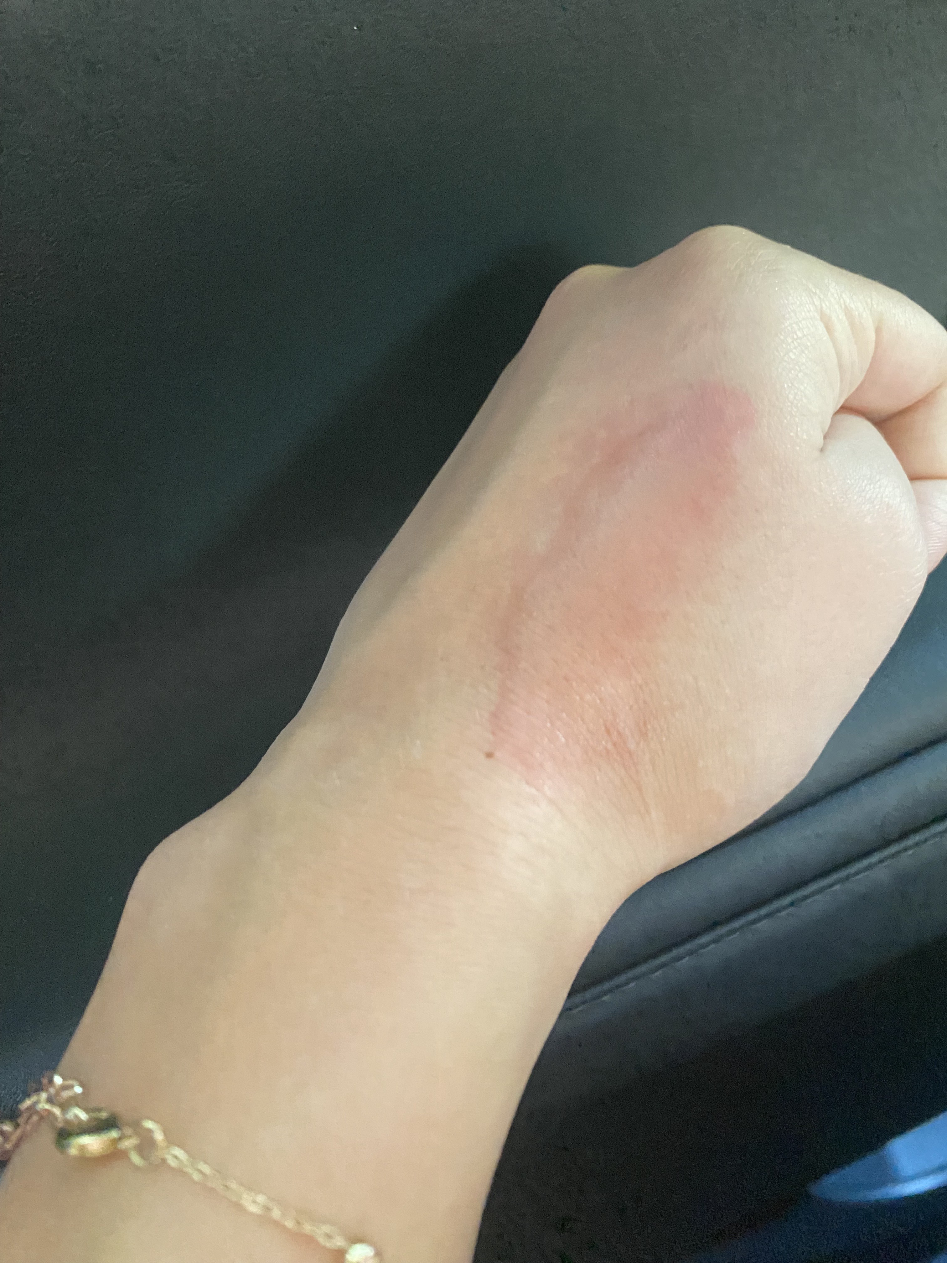 Allergic reaction