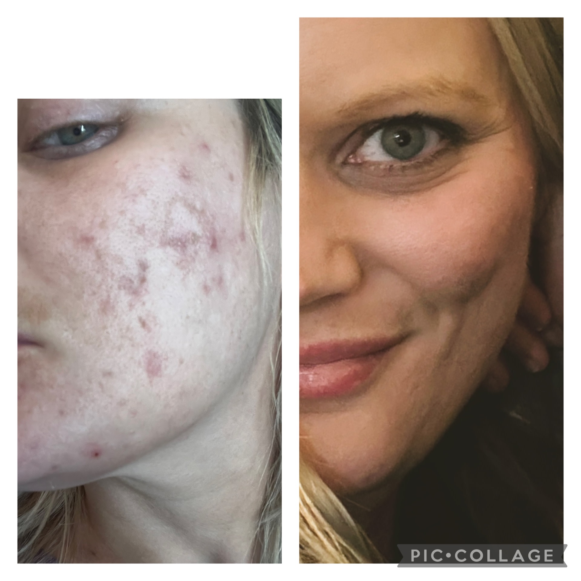 Unedited, no makeup photo 4 months apart