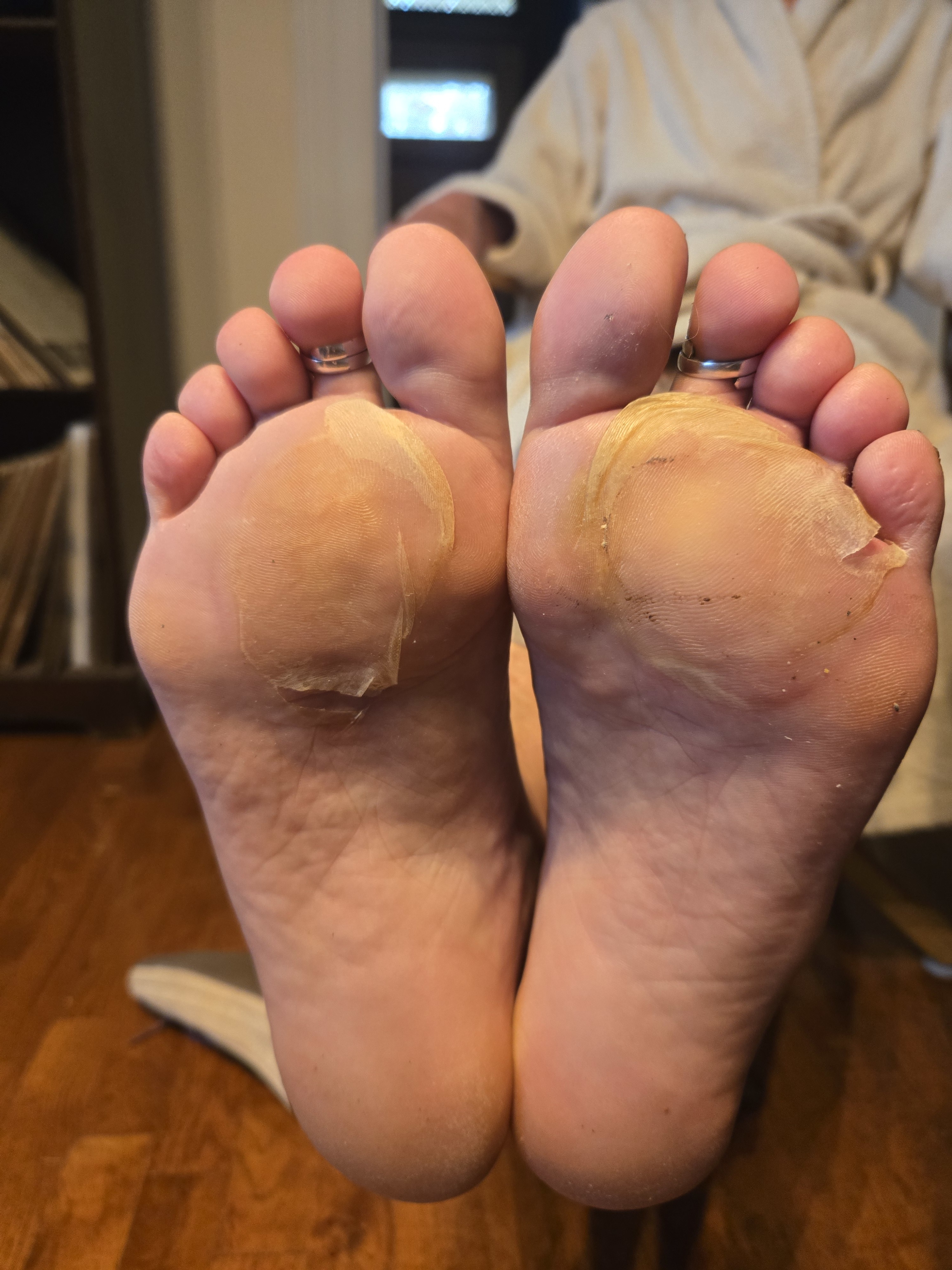 bad blisters turning into calluses