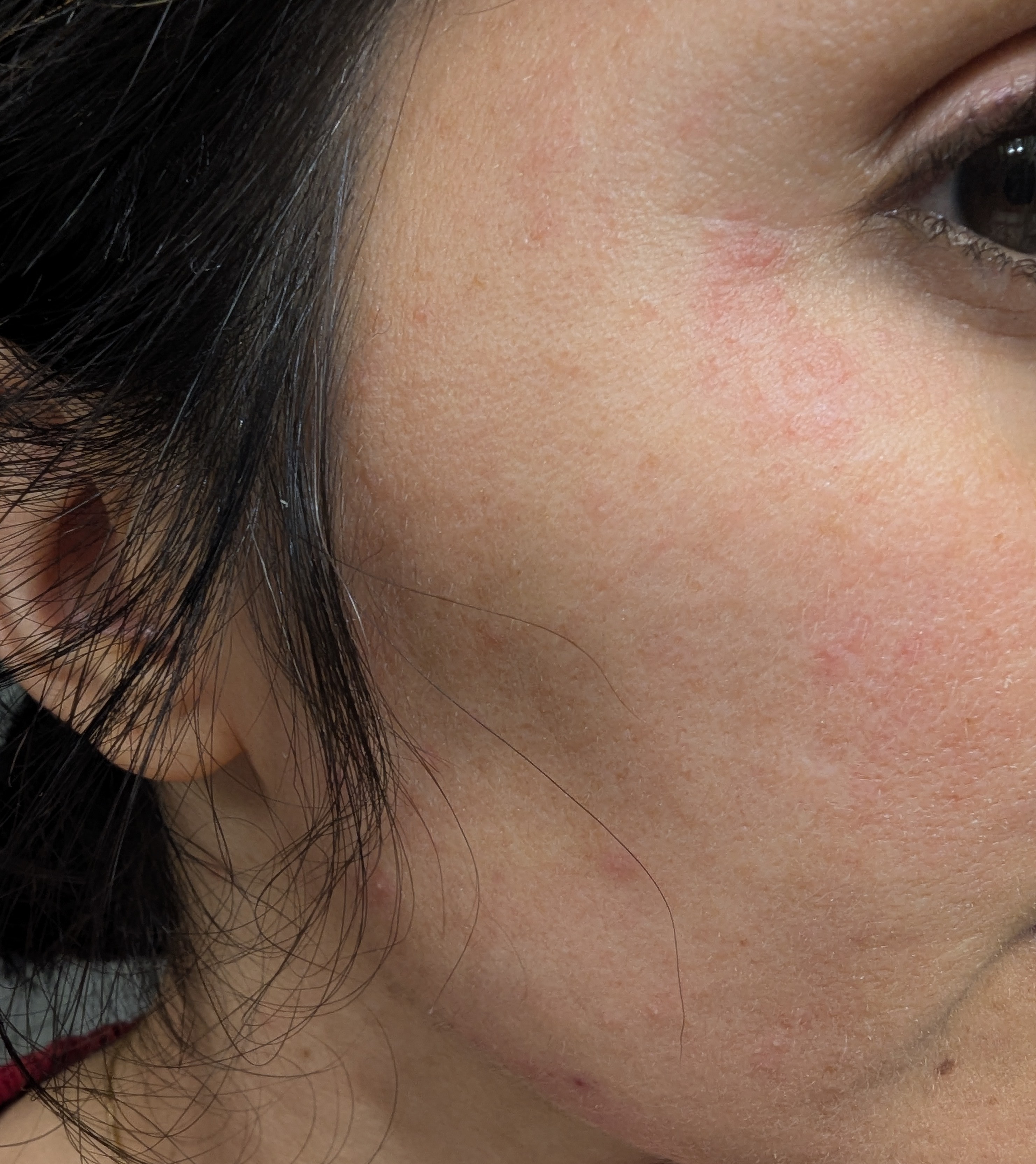 Red spot around eyes