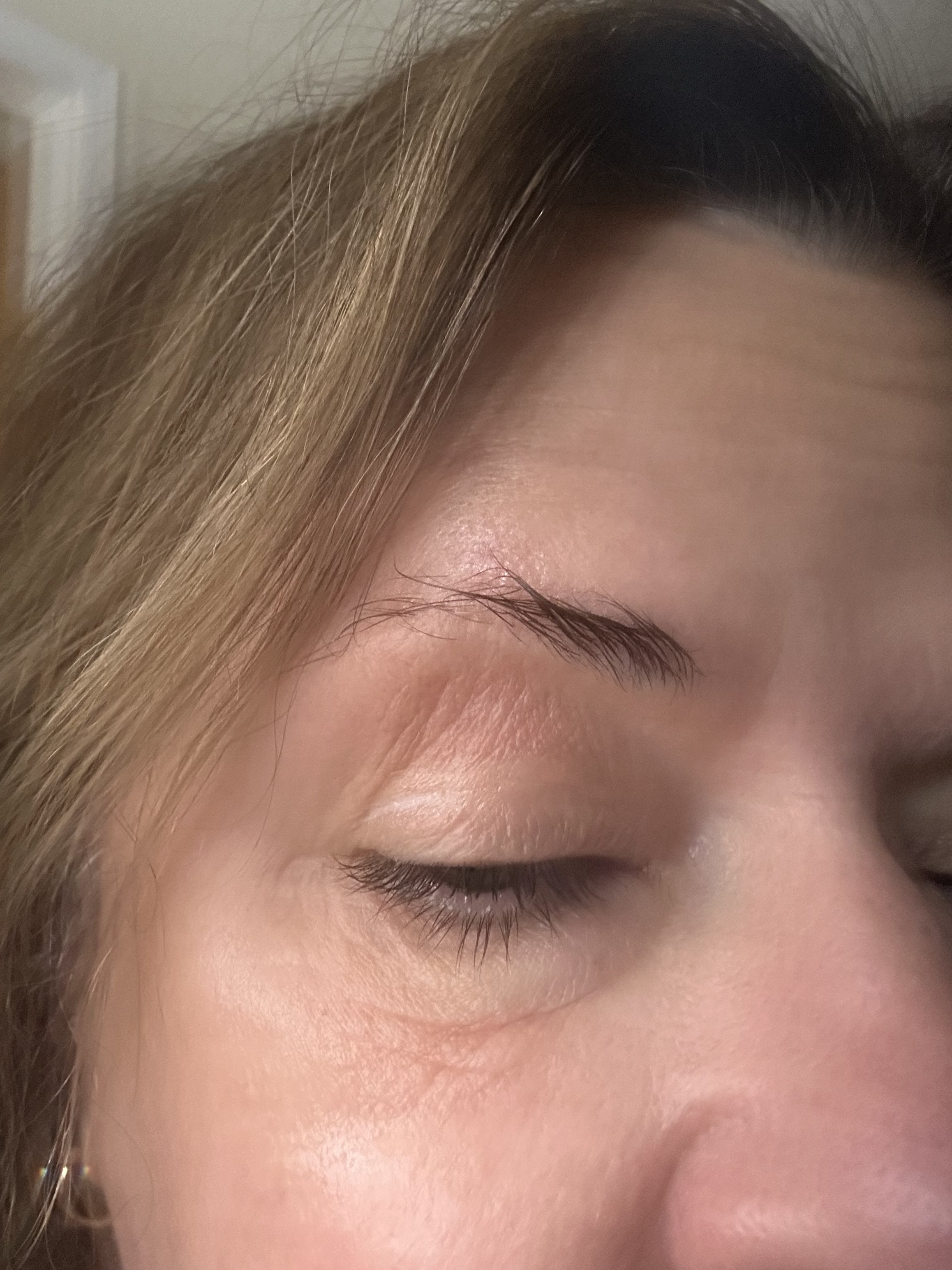 Eye red, swollen and puffy