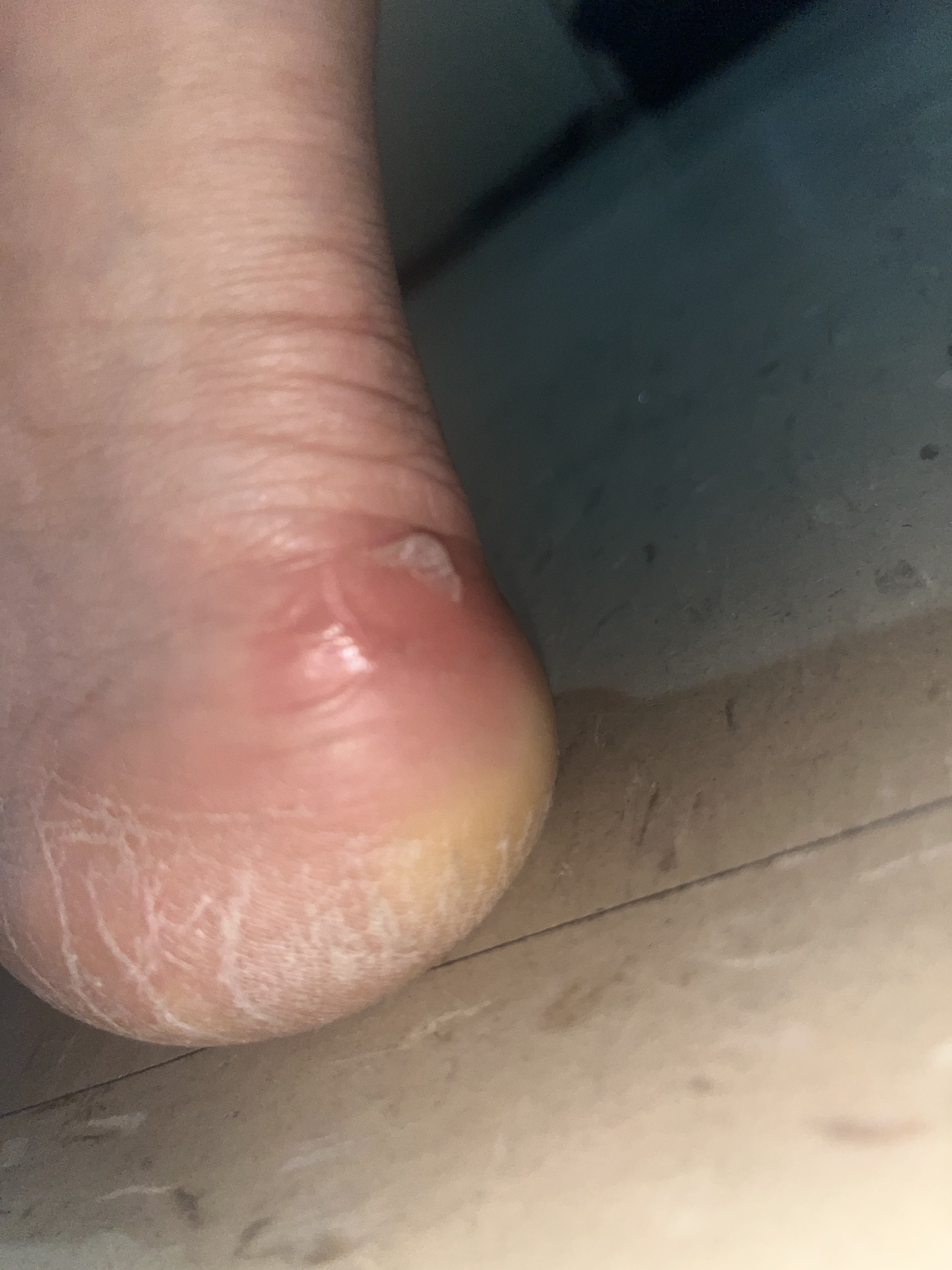 So much friction it cause painful hardening at the base of foot