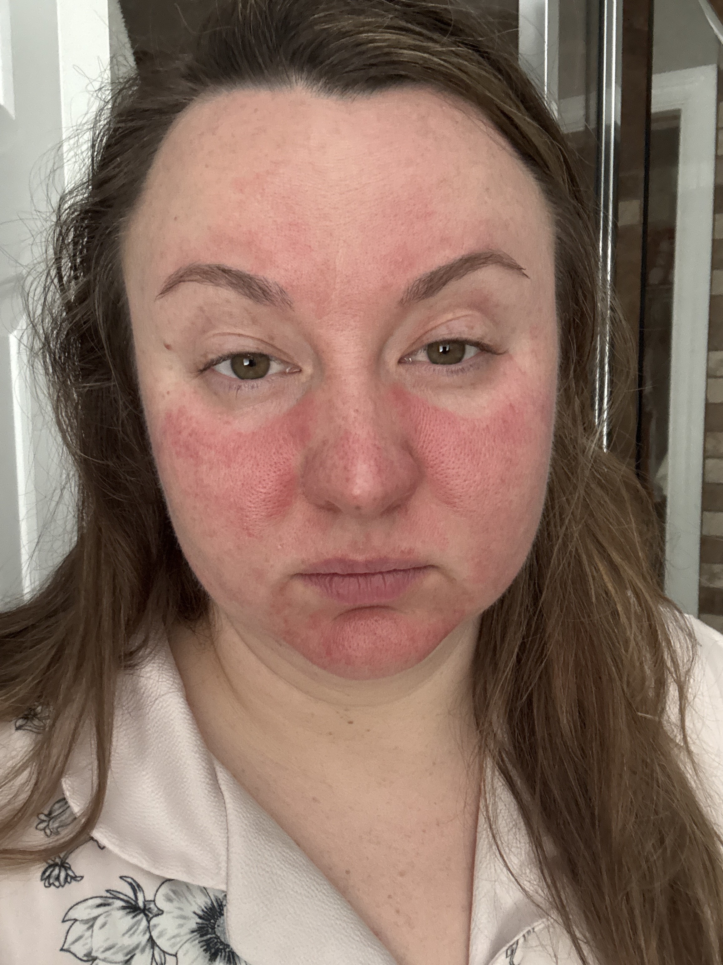 First burns