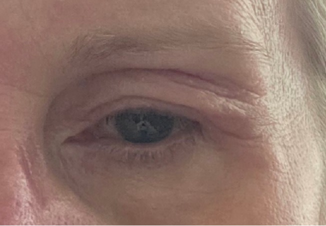 Product Caused Swollen Eyelids