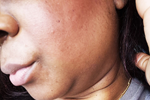 on cheek