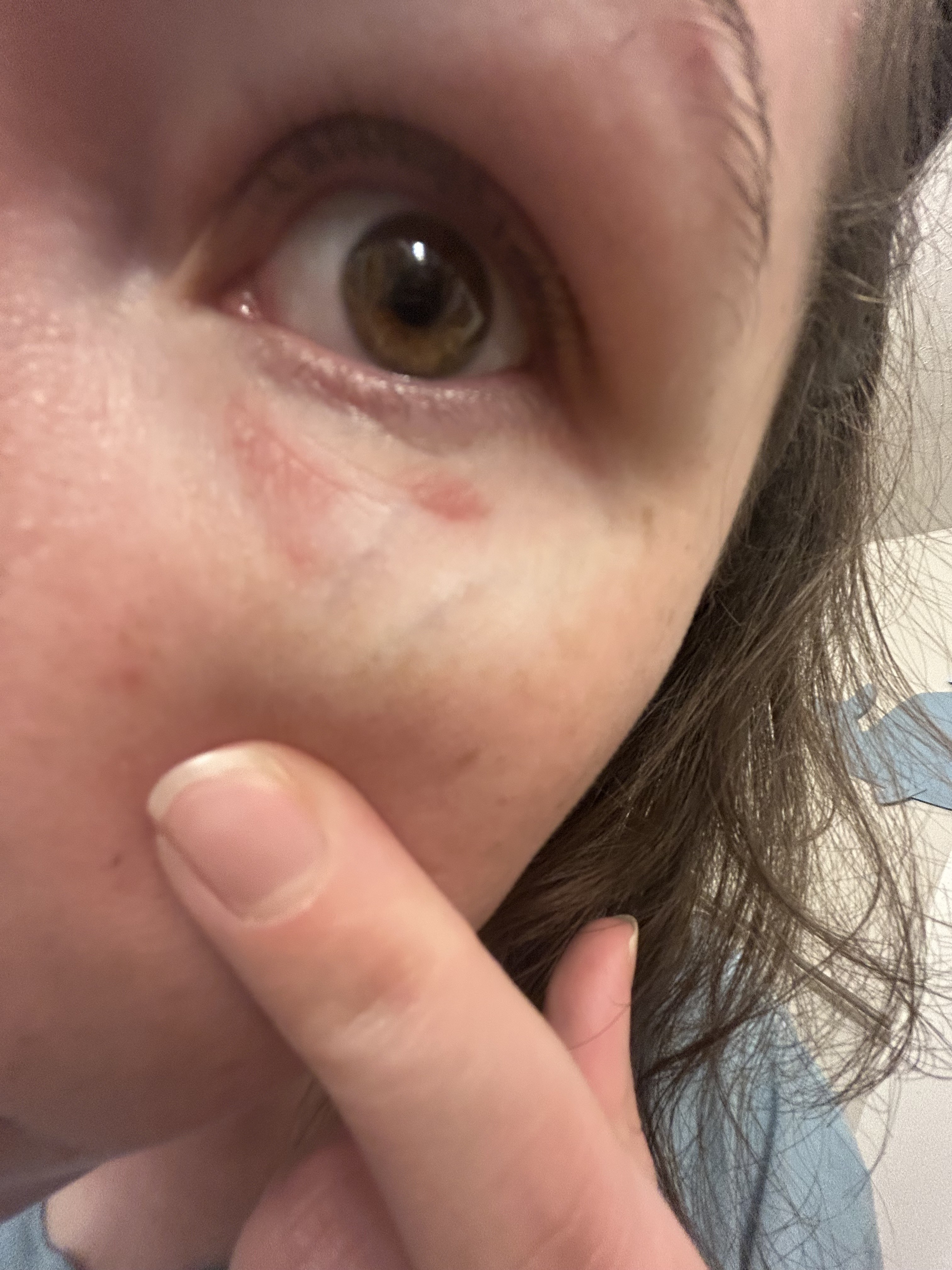 This is after 2 weeks with ointment from a doctor.