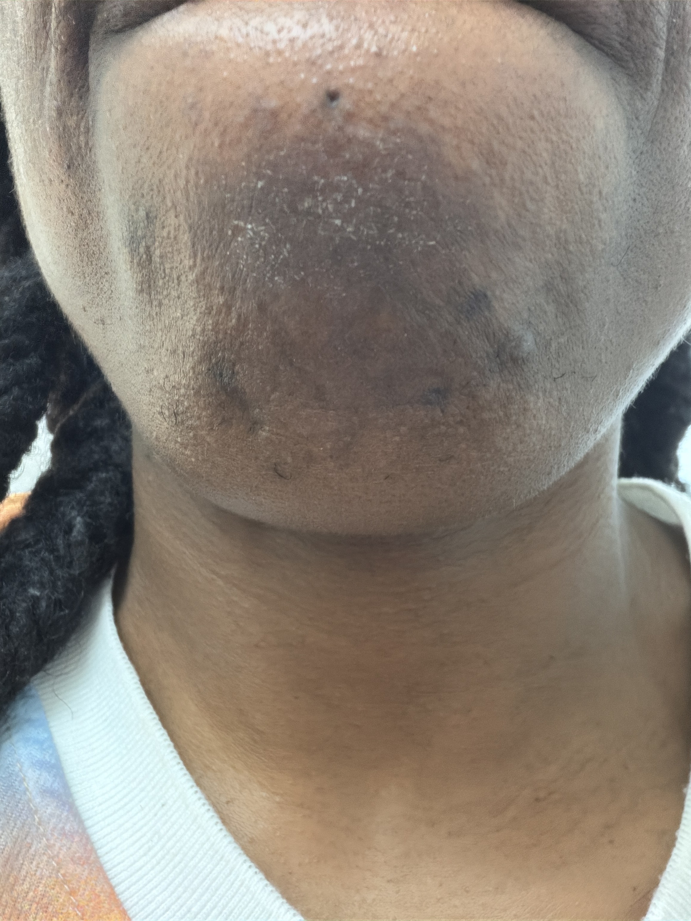 Severe chemical burn to chin area