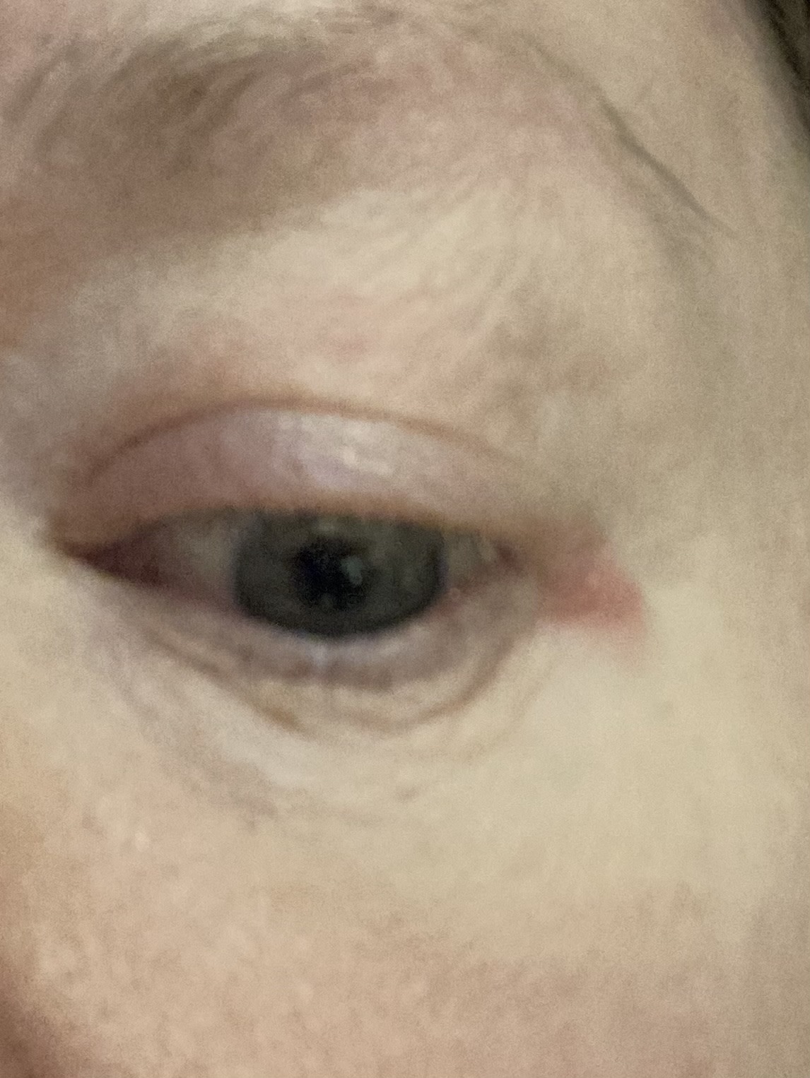 Red area is raised like a blister
