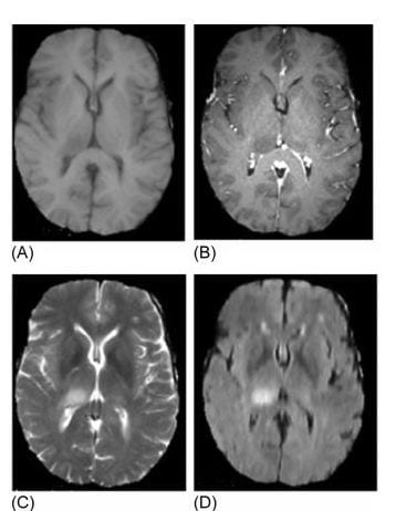 brain scan with tumor