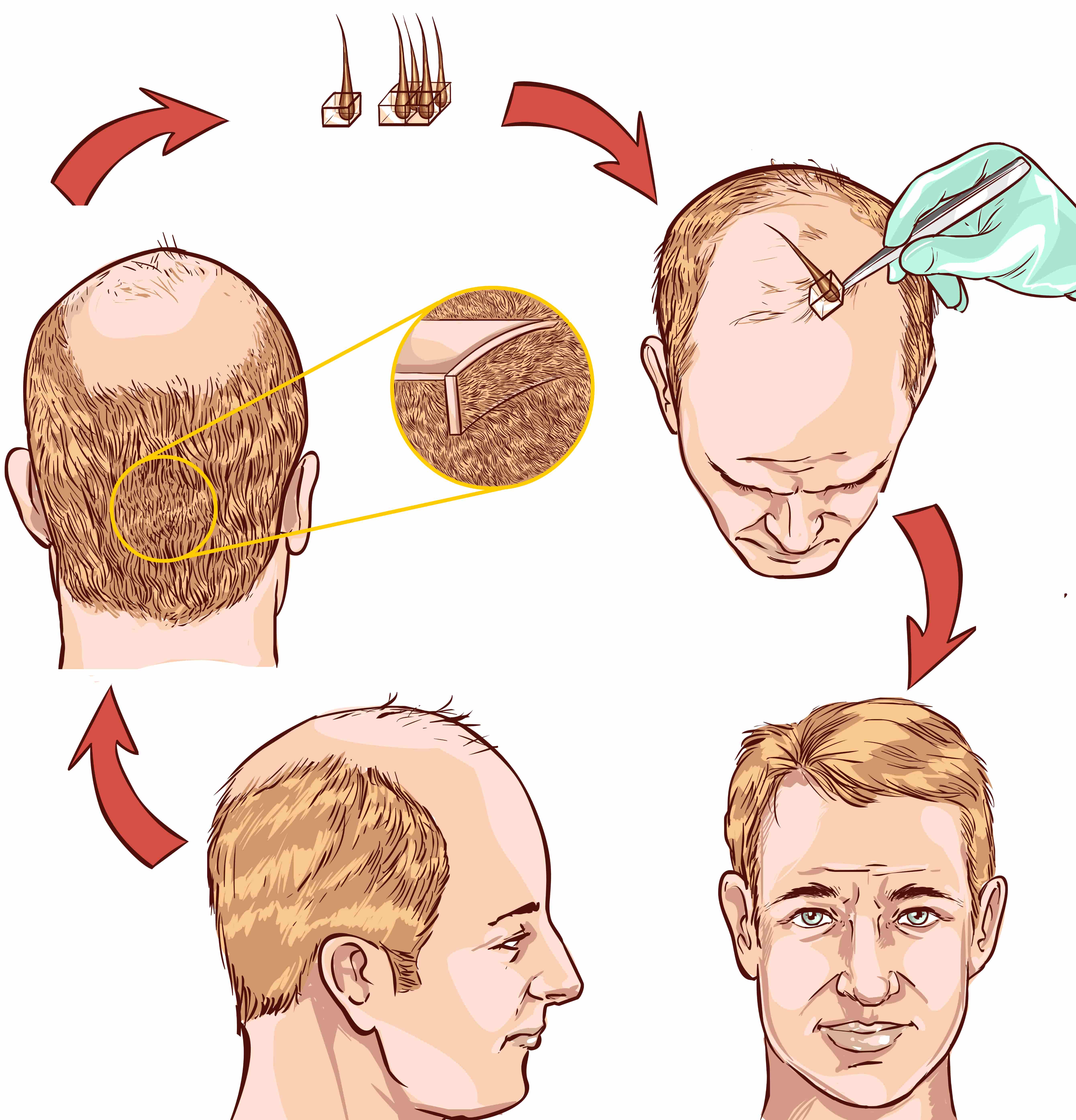 Best Hair Transplant in Chennai  Hair Transplantation Cost Clinic