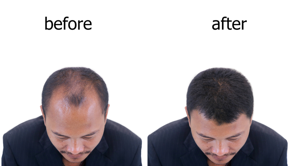 Hair Transplant Clinic in India  Natural Looking Hair Restoration