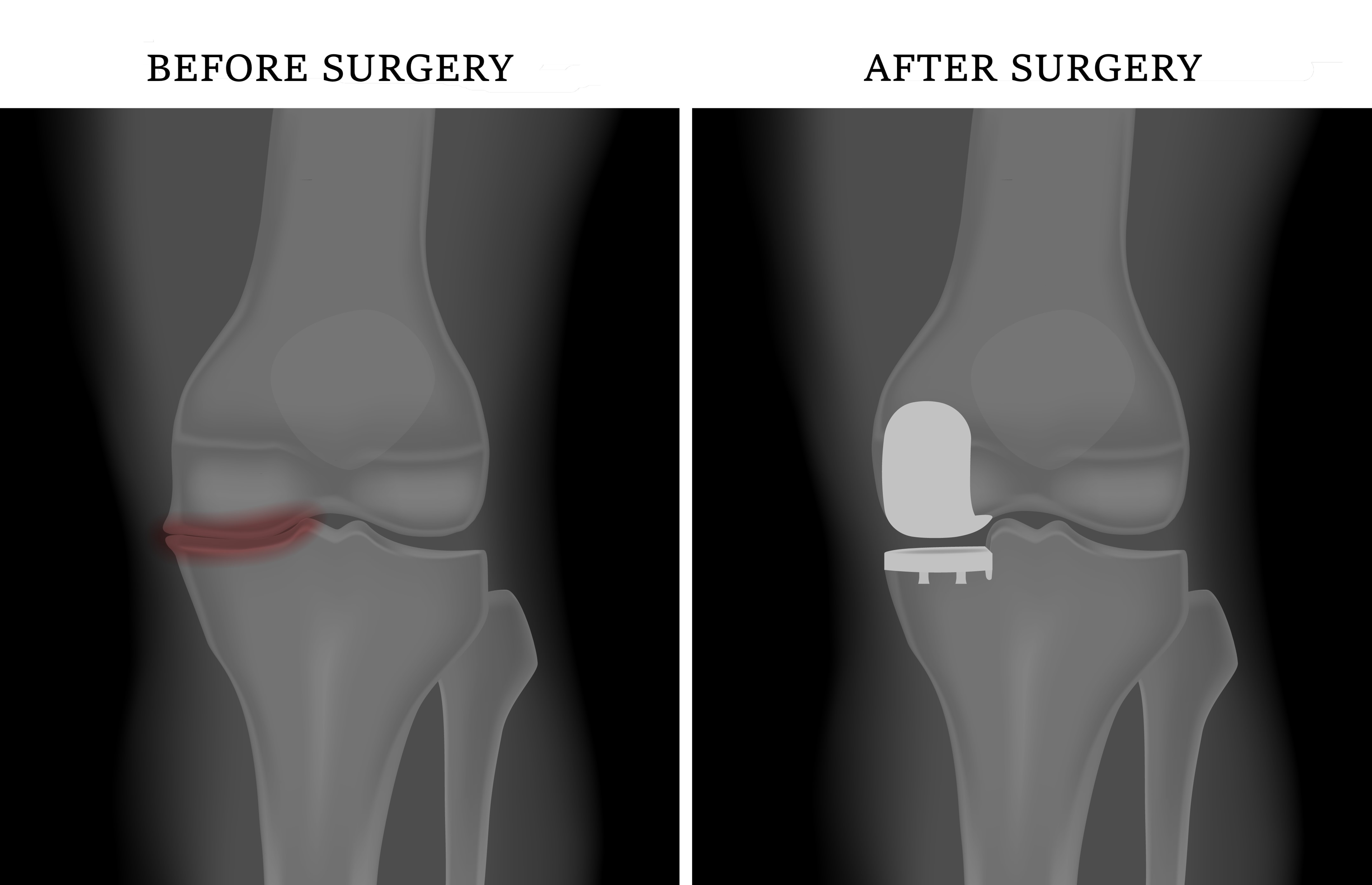 Defender Post-op Knee at best price in Chennai by Amazing Grace