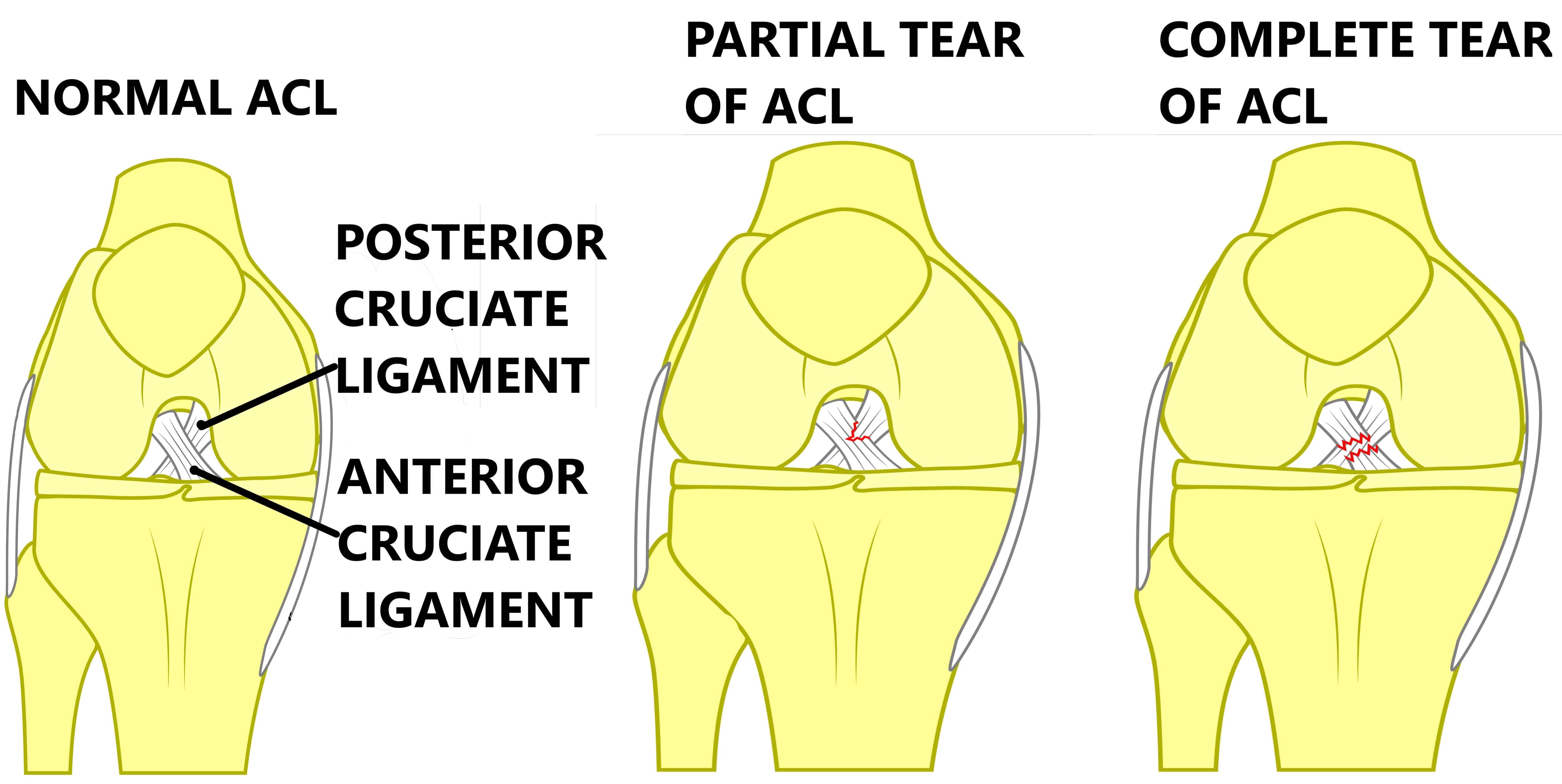 The Benefits of ACL Surgery