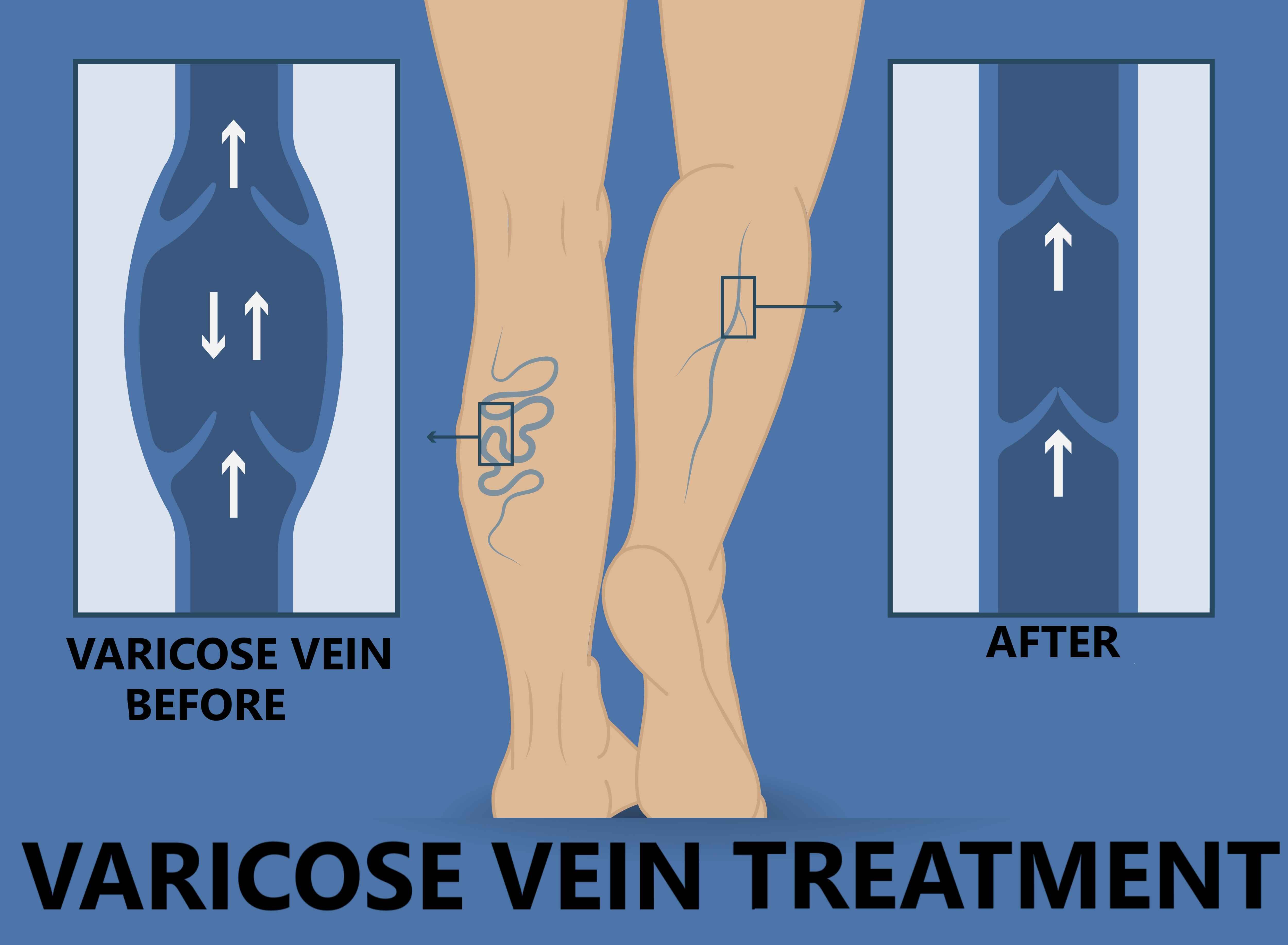 Which Doctor To Consult For Varicose Veins