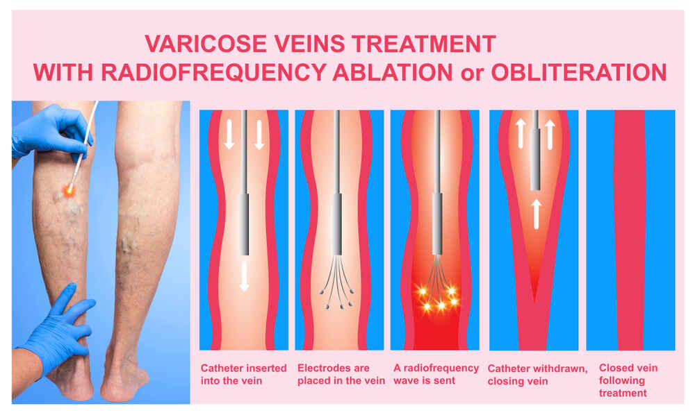 Which Doctor To Consult For Varicose Veins