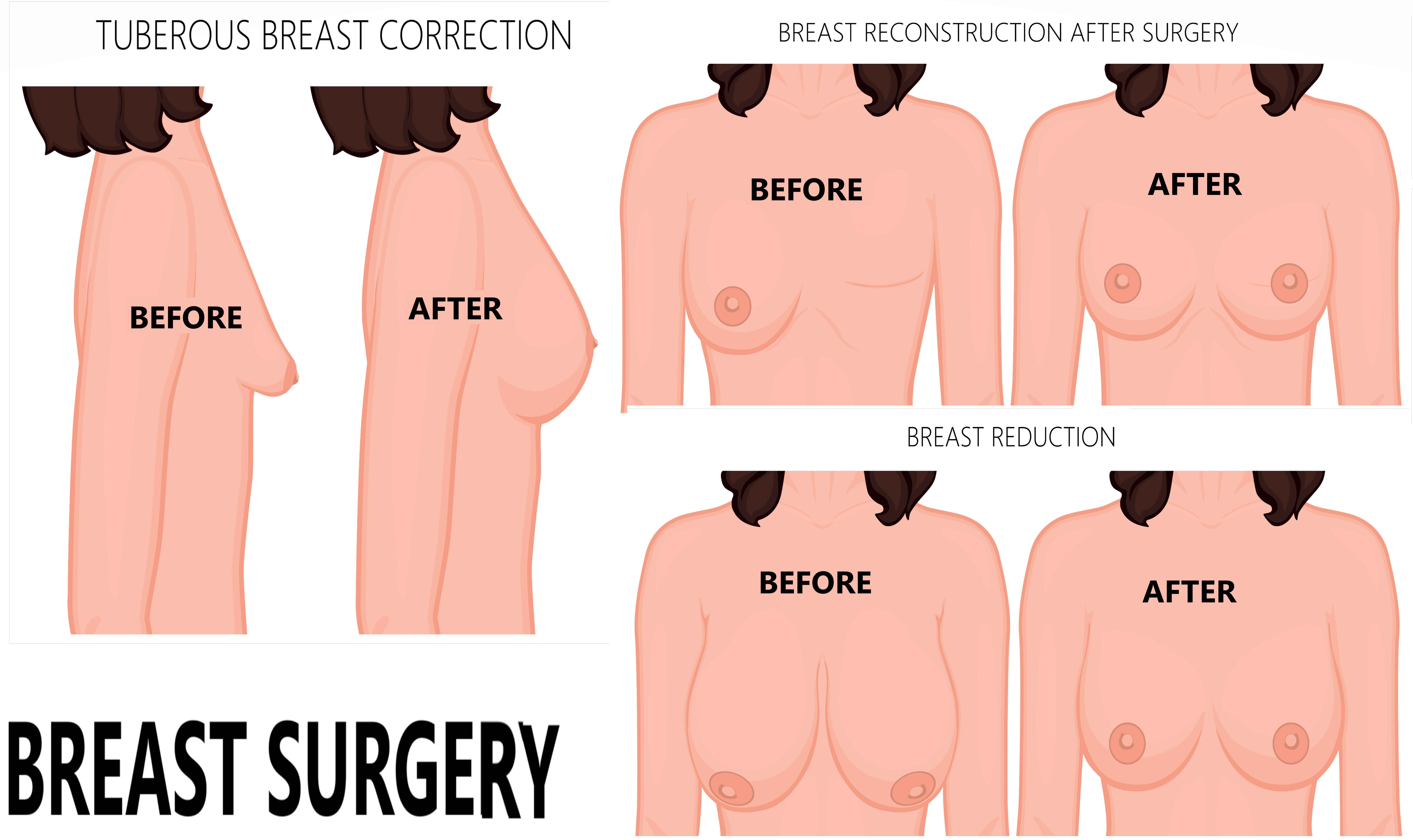 Breast Pain Treatment in Gurgaon Haryana, Best Breast Surgeon in Delhi NCR