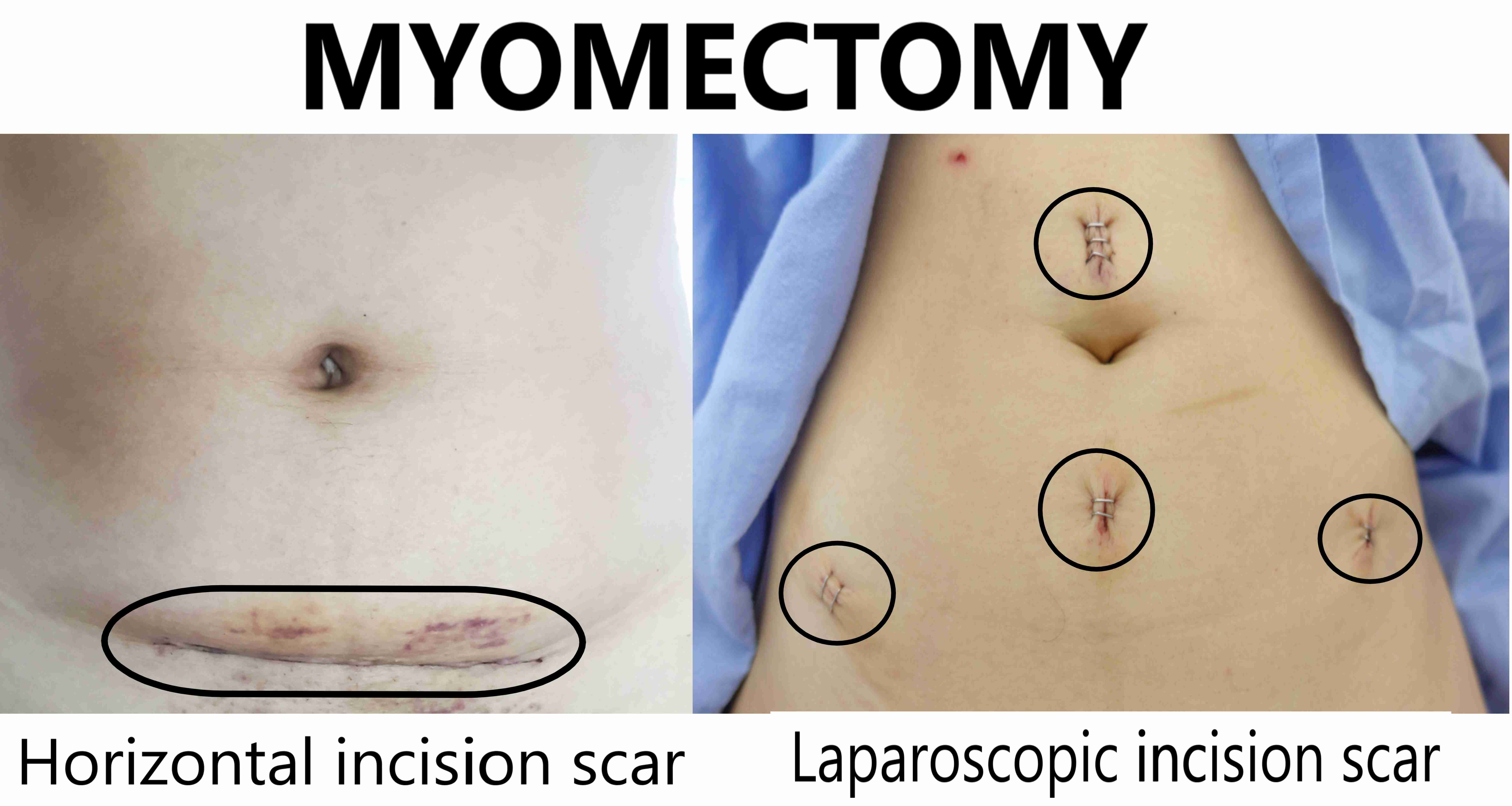 laparoscopic myomectomy scars
