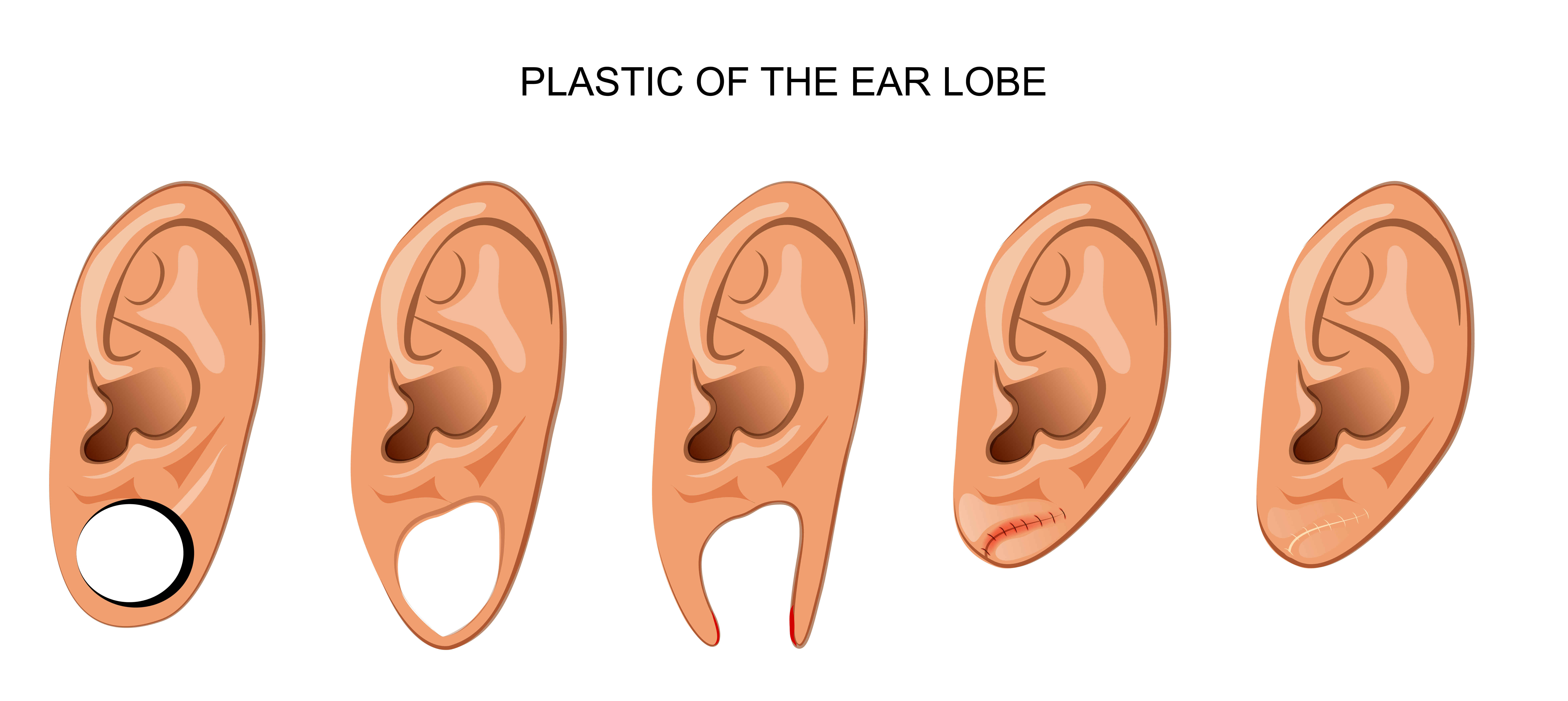 Ear Lobe Repair Treatment In Dlf Phase 4