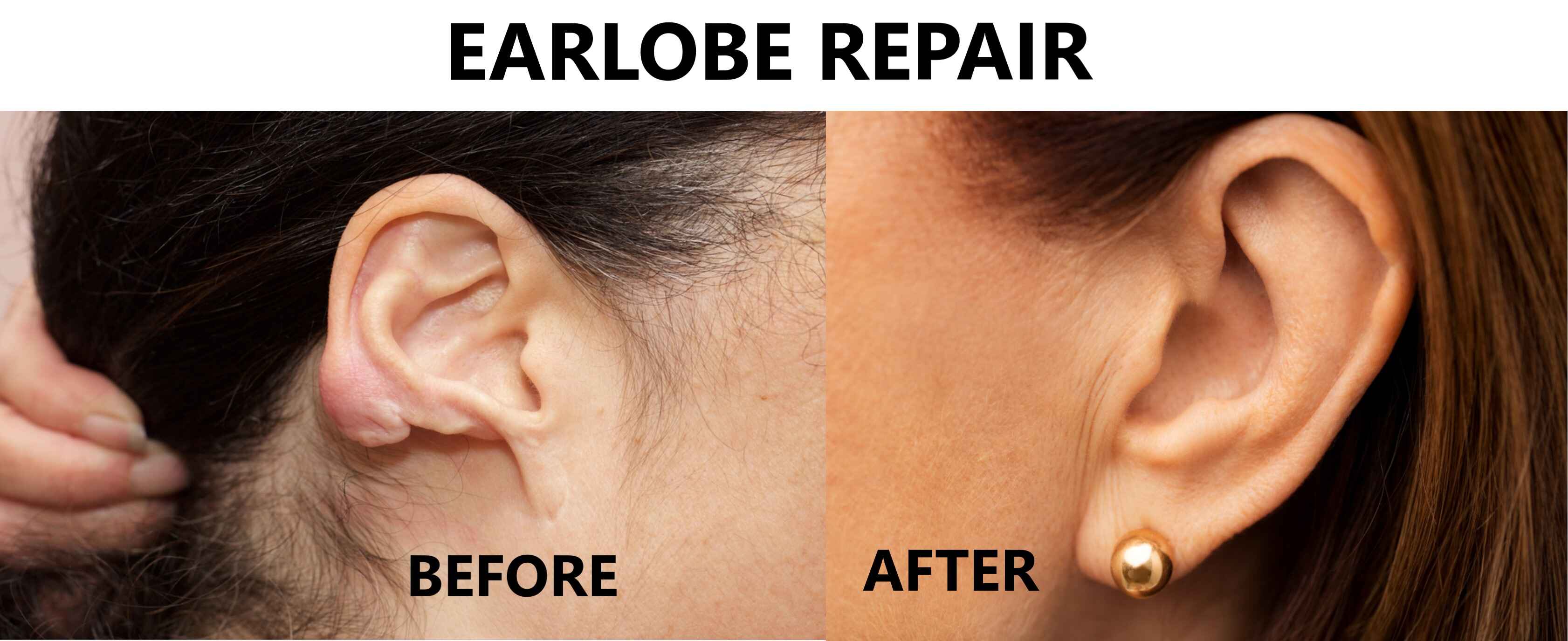 Ear Lobe Repair Treatment In Dlf Phase 4