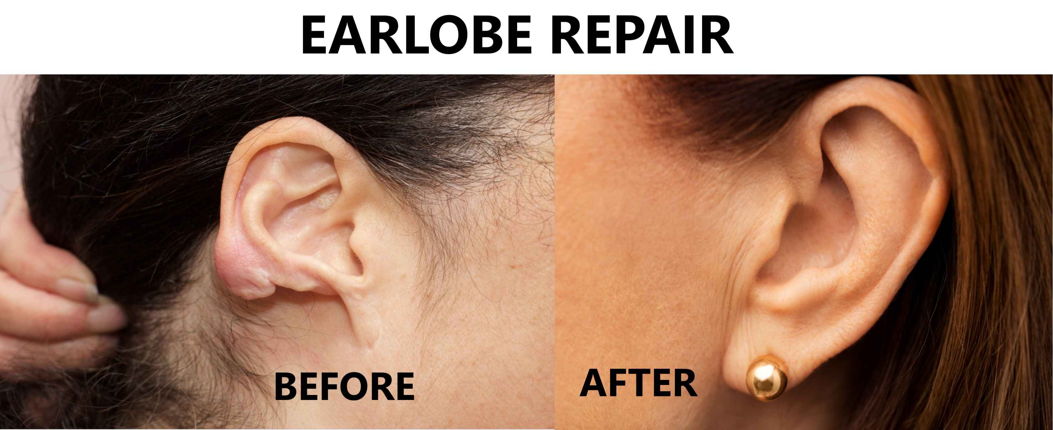 Ear Lobe Repair in South Delhi, Saket