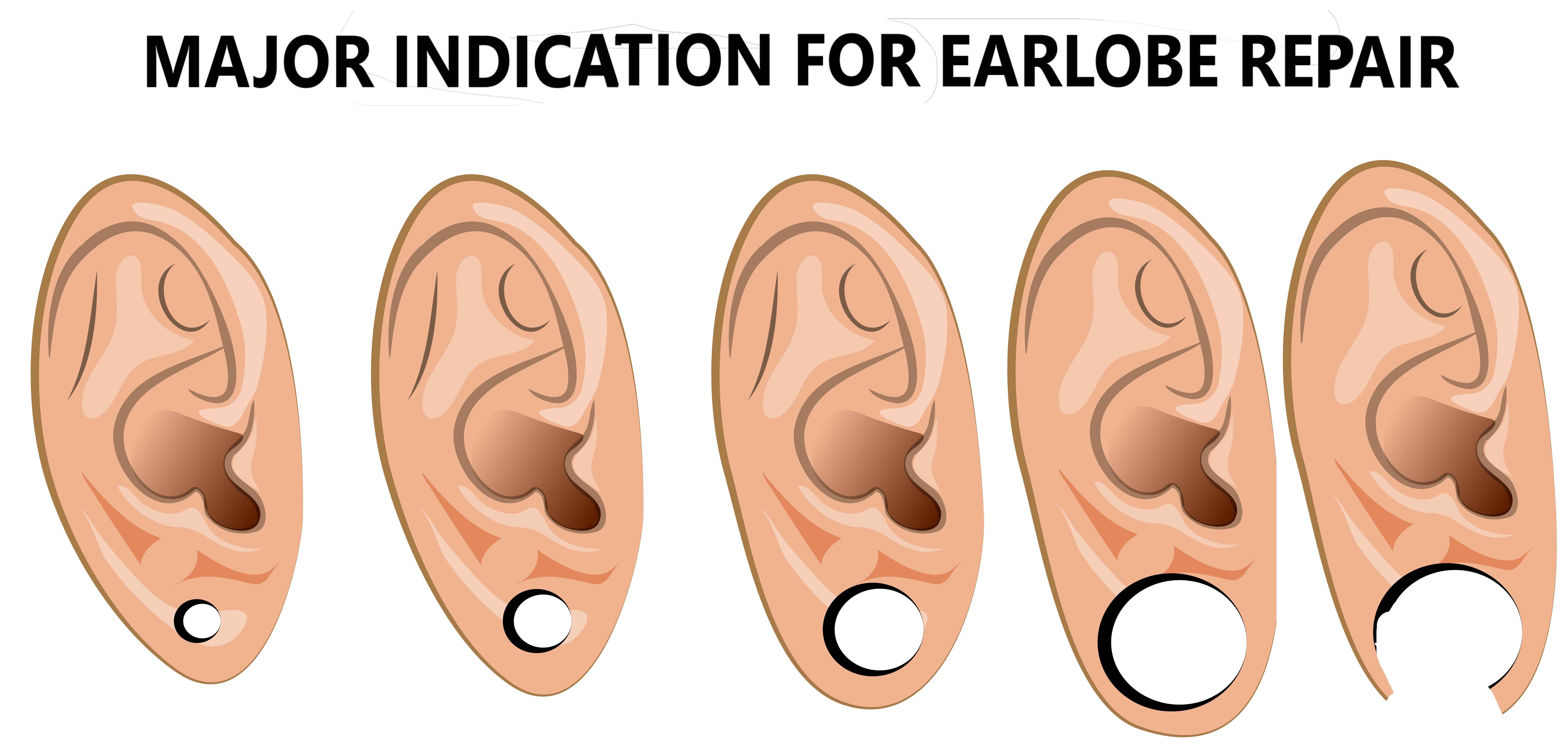 Earlobe Repair in Jaipur  Suture Free Earlobe Repair Treatment in