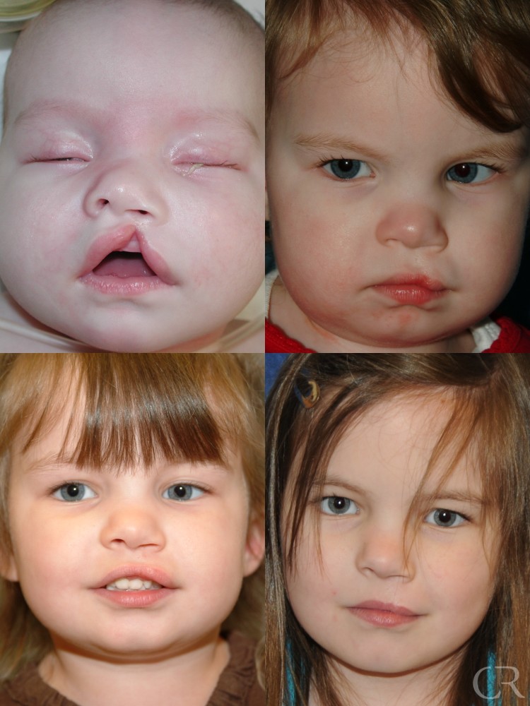 cleft lip palate Overview clefts of the lip and palate occur in roughly 1 in 1000 births, making clefts one of the most common congenital anomalies that we see in our center. cleft lip palate Overview clefts of the lip and palate occur in roughly 1 in 1000 births, making clefts one of the most common congenital anomalies that we see in our center.