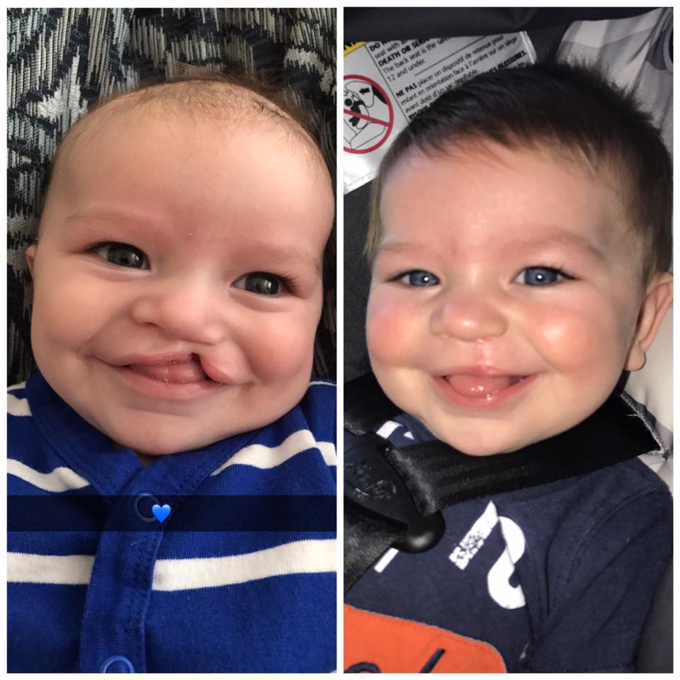 cleft lip palate surgery in kentucky dr mark chariker cleft lip repair