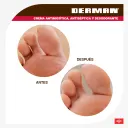 Derman 20.36/100 G Crema Antimicótica Con 50 G