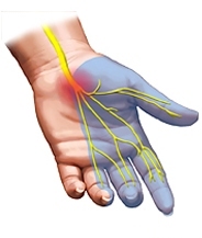 carpaltunnel fumih0 - Carpal Tunnel Syndrome (Sindroma Terowongan Karpal)