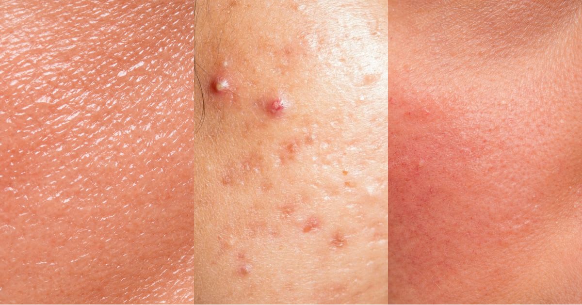 Triptych close-up of skin in three conditions side by side — smooth dehydrated skin on the left, active inflammatory acne with pustules in the center, and irritated reactive redness on the right — illustrating how different triggers manifest on the face.