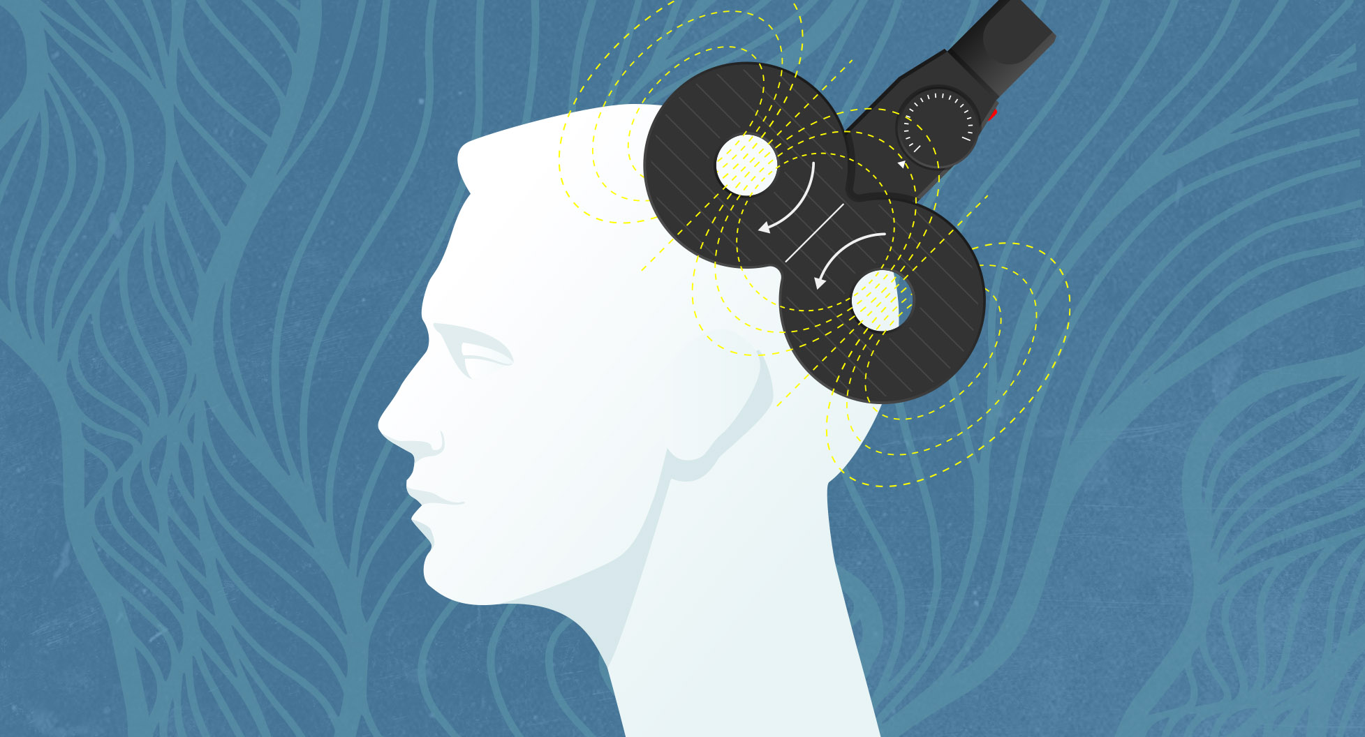 TMS Treatment for Depression