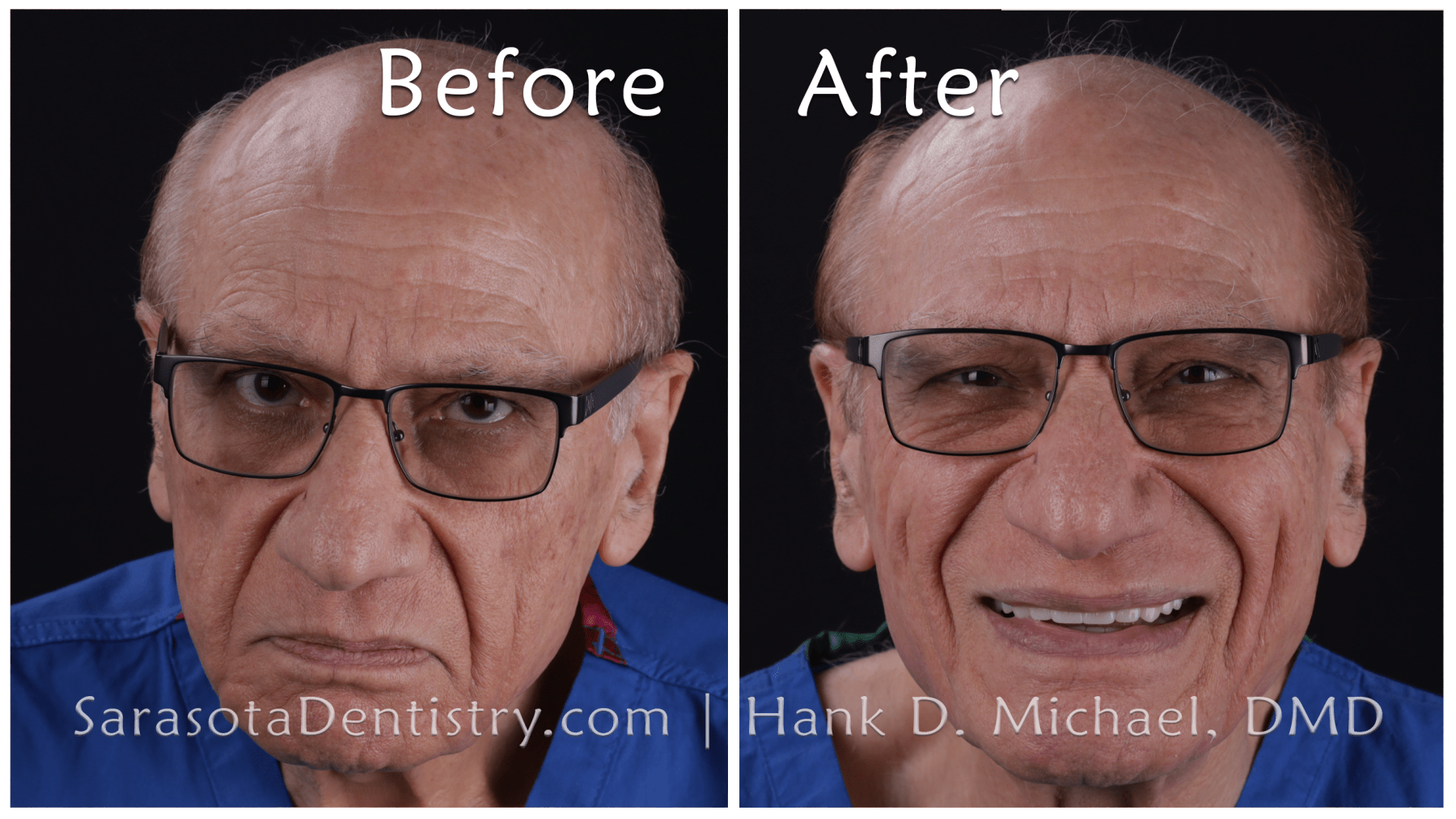 Dental Implants with Porcelain Crowns Smile Makeover - Before and After