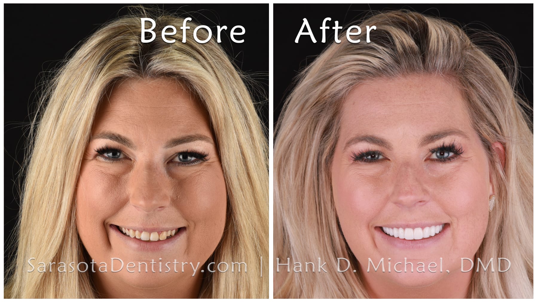 Porcelain Crowns Smile Makeover --- Before and After