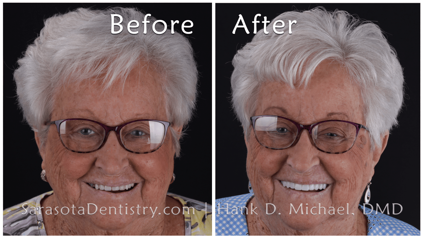 Smile Makeover with Dental Implants - Porcelain Bridge --- Before and After