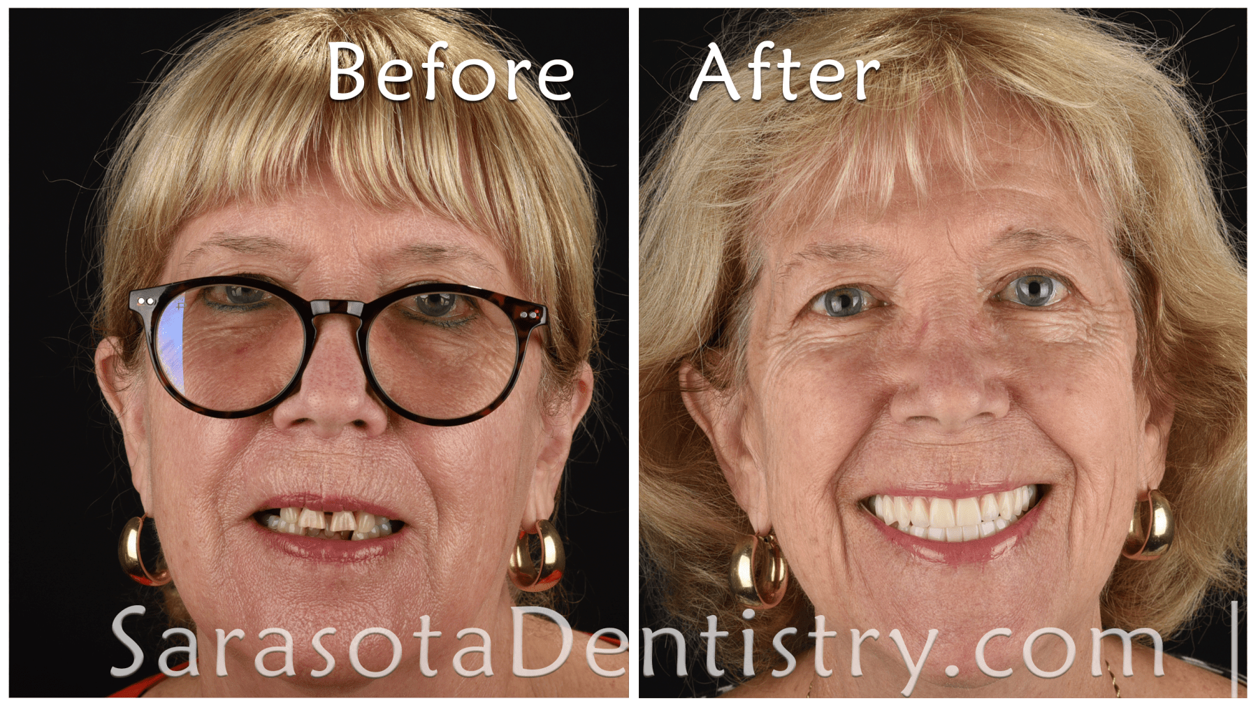 Life Changing Smile with Implants Crown and Denture --- Before and After