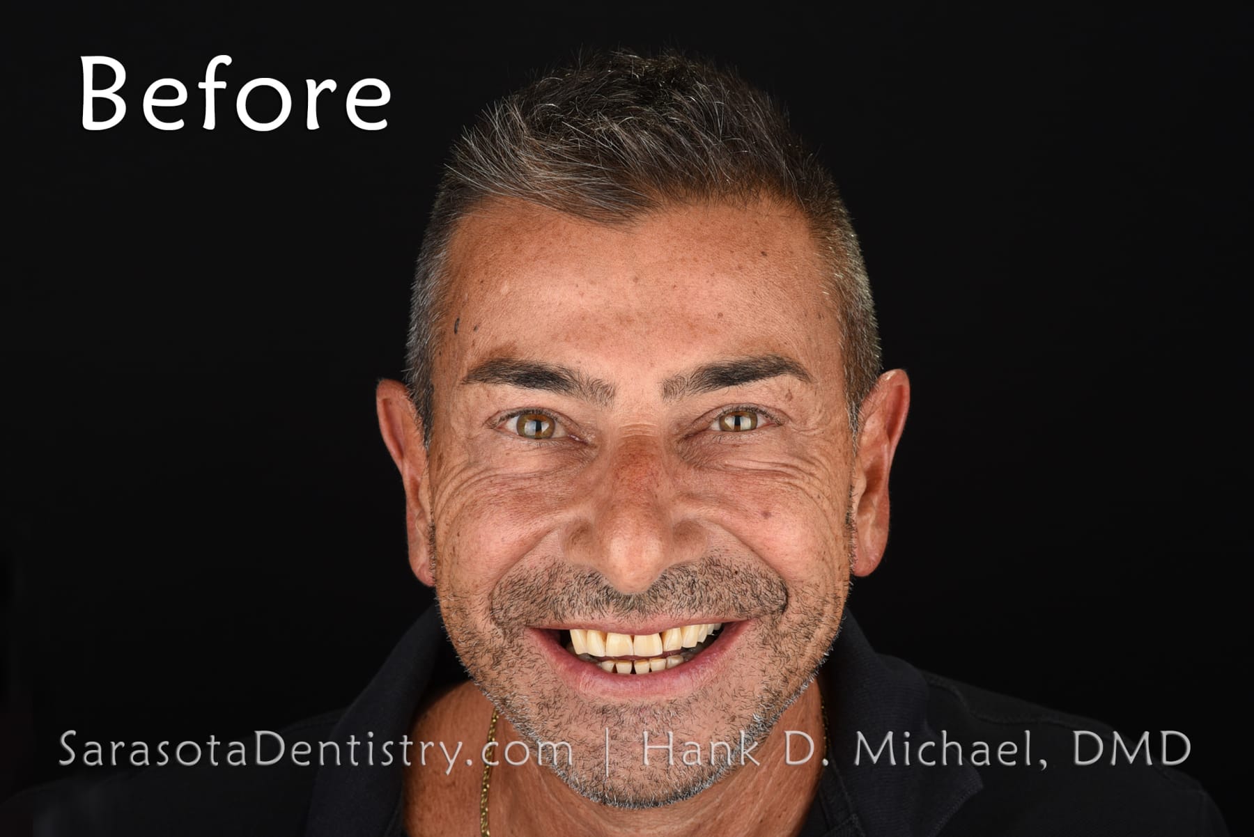 Amazing Smile Makeover - Dental Implants & Zirconia Porcelain Crowns — view 1