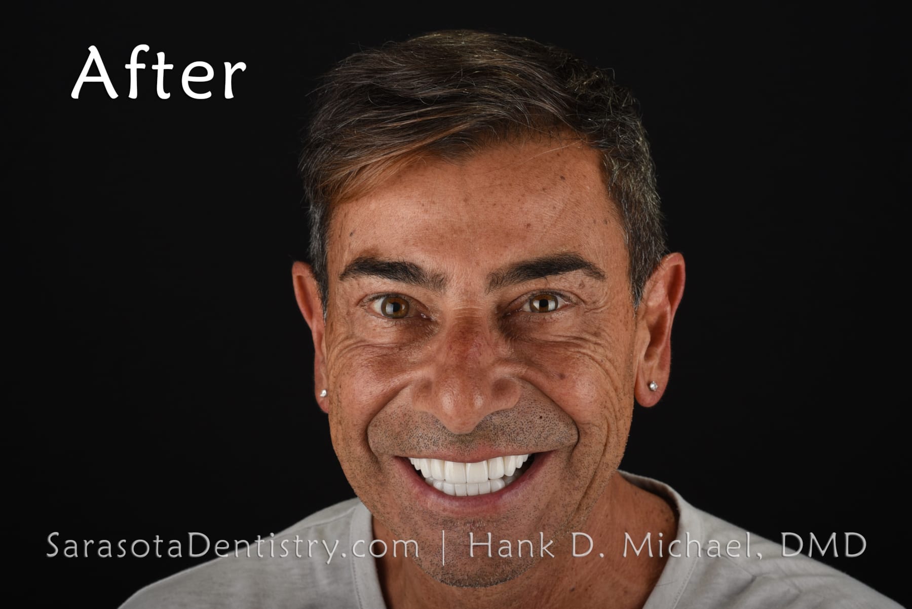 Amazing Smile Makeover - Dental Implants & Zirconia Porcelain Crowns — view 2