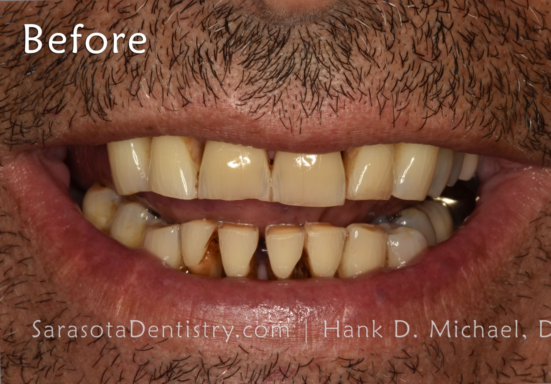 Amazing Smile Makeover - Dental Implants & Zirconia Porcelain Crowns — view 3