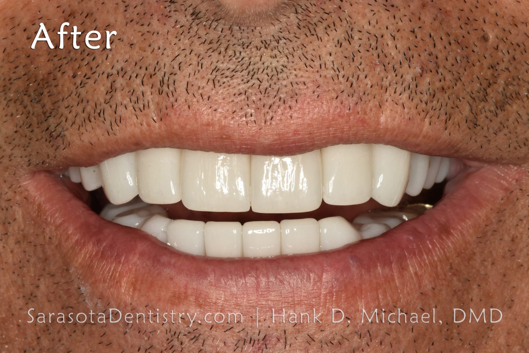Amazing Smile Makeover - Dental Implants & Zirconia Porcelain Crowns — view 4
