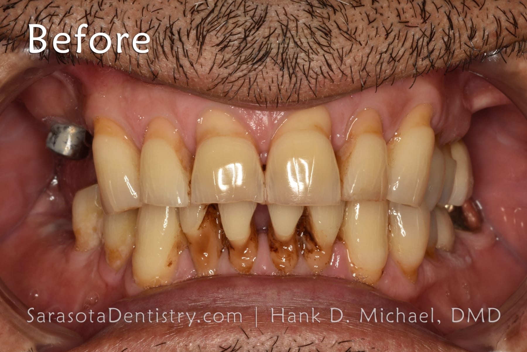 Amazing Smile Makeover - Dental Implants & Zirconia Porcelain Crowns — view 5