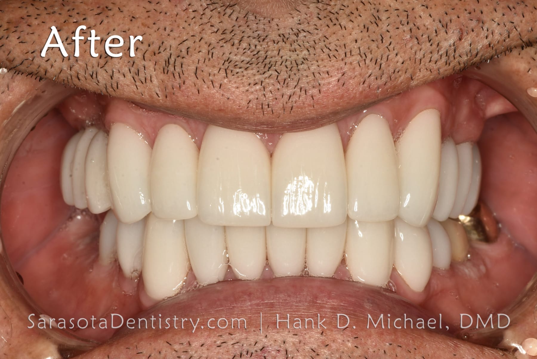 Amazing Smile Makeover - Dental Implants & Zirconia Porcelain Crowns — view 6