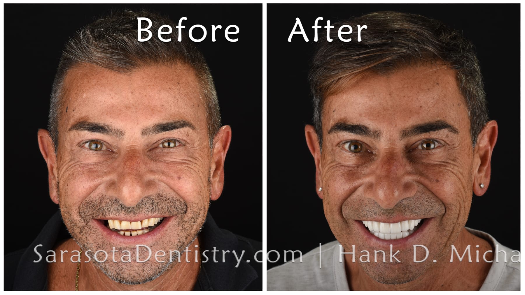 Amazing Smile Makeover - Dental Implants & Zirconia Porcelain Crowns — view 7
