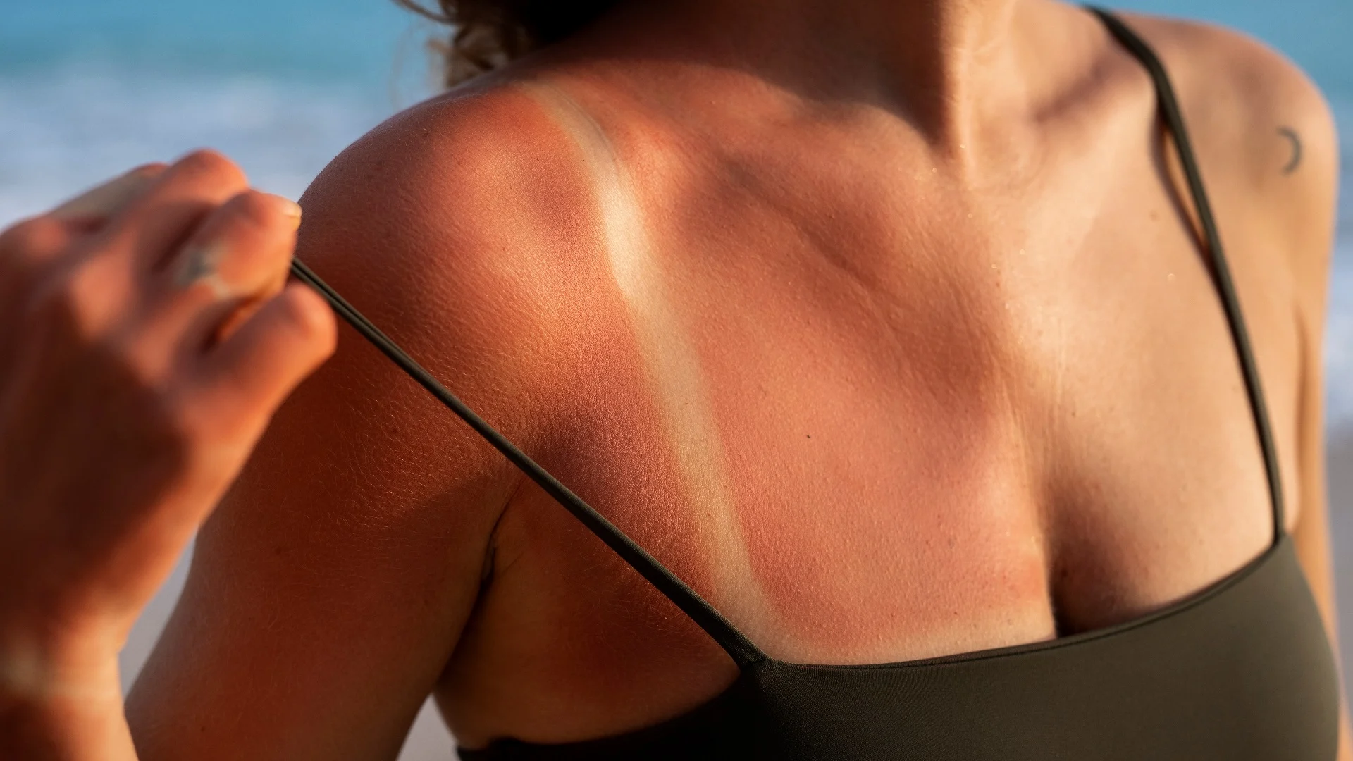 Dermatitis Solar